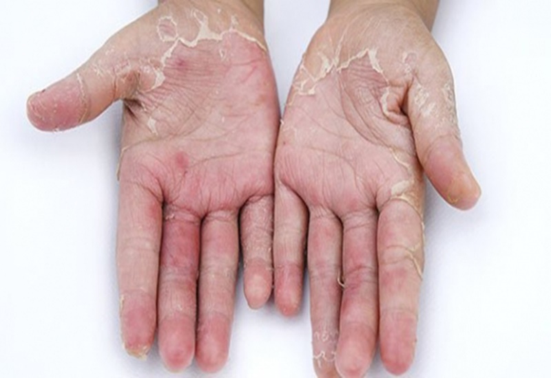 Da tay khô có thể là do bệnh lý