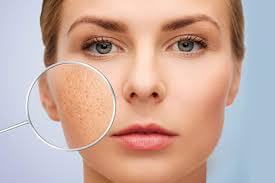 Chia sẻ cách chăm sóc da mặt bị sẹo rỗ tại nhà