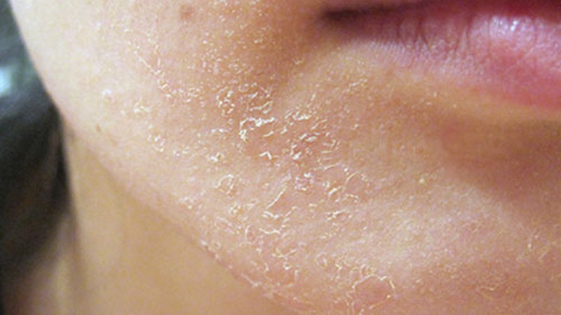 Làm sạch làn da ngăn ngừa mụn xuất hiện