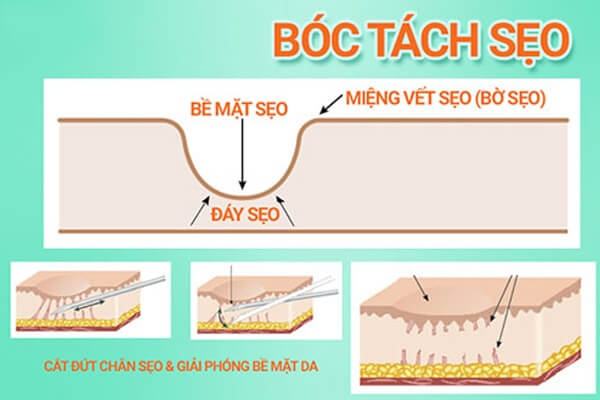 Hướng Dẫn Chăm Sóc Da Sau Khi Bóc Tách Sẹo Kiểm duyệt