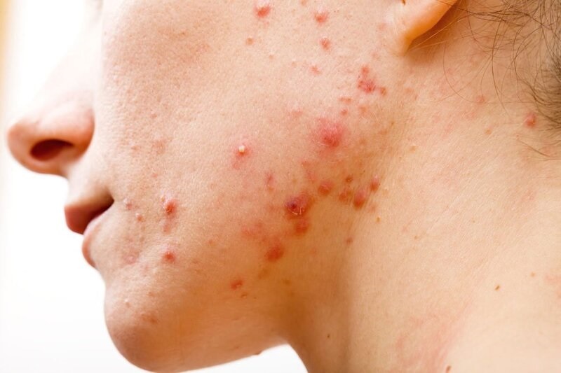 Cách chăm sóc da mặt bị mụn vào ban ngày sẽ có sự khác biệt so với ban đêm