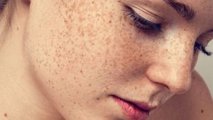 chăm sóc da sau khi đốt tàn nhang thế nào?