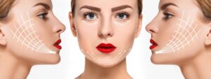 Căng da mặt bằng chỉ collagen là một trong những phương pháp làm đẹp hiện đại mà không cần sự can thiệp của phẫu thuật