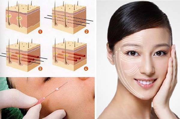 Phương pháp căng da mặt bằng chỉ collagen nhanh chóng trở nên phổ biến