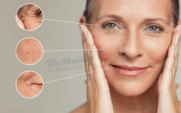 Căng da bằng chỉ collagen có tốt không? Chuyên gia chia sẻ