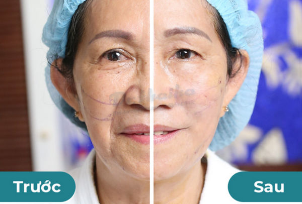Căng da mặt bằng chỉ collagen duy trì được bao lâu