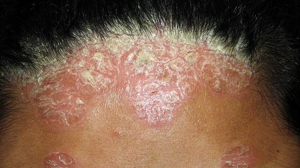 Vảy xuất hiện trên da đầu do ảnh hưởng của bệnh