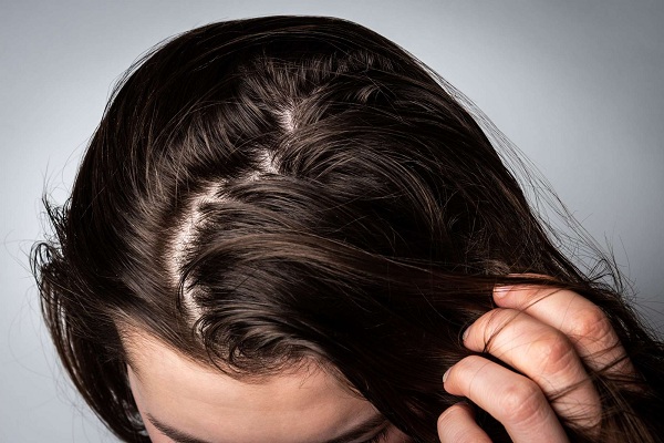 Chăm sóc da dầu khỏe mạnh là tiền đề để nuôi dưỡng tóc chắc khỏe