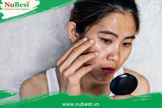 Da mặt bị đen sạm do nhiều nguyên nhân gây ra