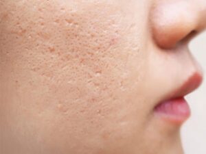 Da mặt bị rỗ có thể phục hồi được tùy vào tình trạng và phương pháp áp dụng