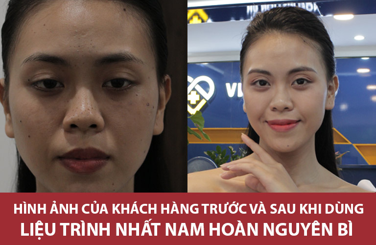 Hình ảnh làn da của chị Trang sau khi dùng liệu trình xử lý mụn Nhất Nam Hoàn Nguyên Bì