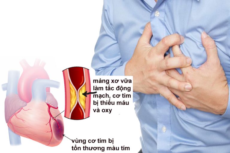 chữa mỡ máu bằng tỏi