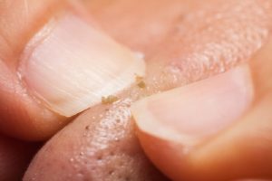 Nặn mụn không đúng cách có thể dẫn đến những hậu quả tổn hại đến da
