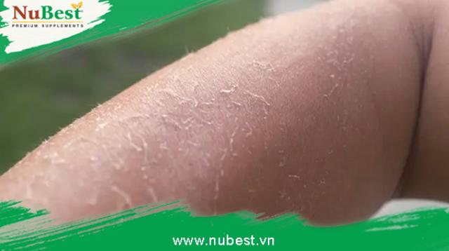 Biểu hiện của làn da bị khô