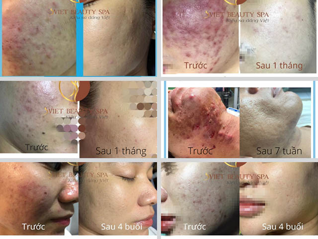 Trị mụn uy tín tại Hà Nội SViet Beauty Spa hình ảnh trước và sau