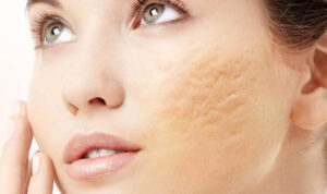 Sử dụng mật ong để tái tạo da mặt bị rỗ hiệu quả