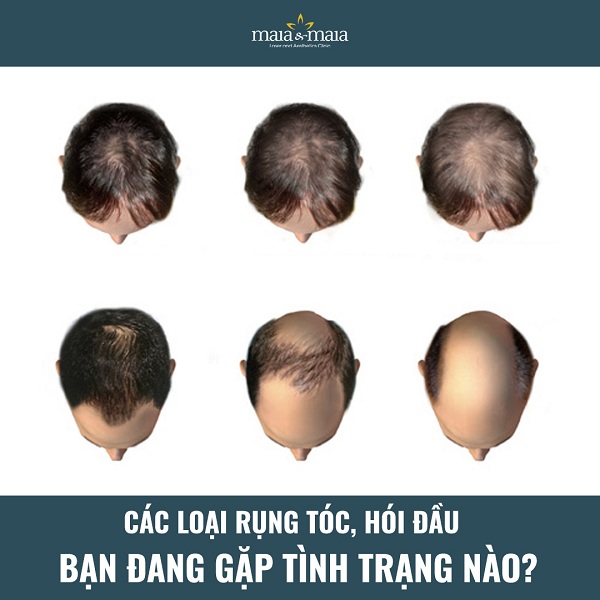 Nếu không chăm sóc tốt, tóc dễ bị rụng và hói đầu