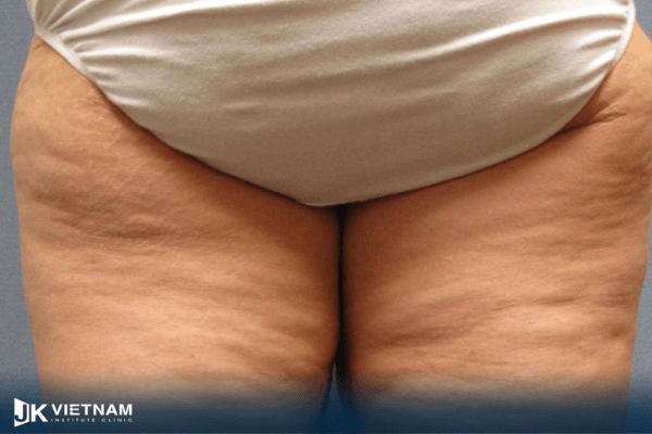 bài tập giảm mỡ mông