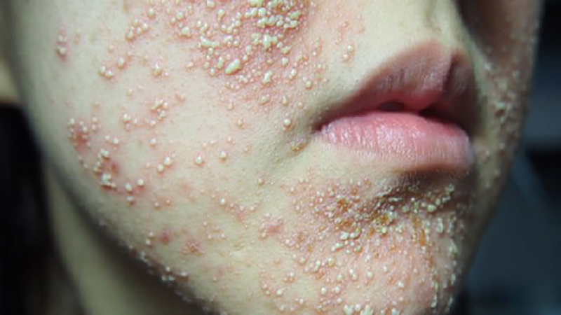 Da mặt xuất hiện tình trạng thường xuyên nổi bong bóng mỗi khi bôi mỹ phẩm