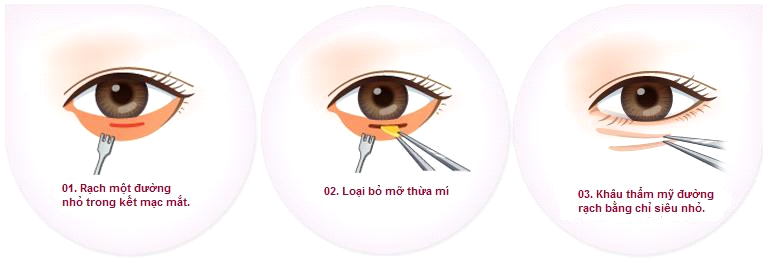 Bọng mắt dưới là gì? Cách chữa trị bọng mắt dưới hiệu quả nhất - hình 10