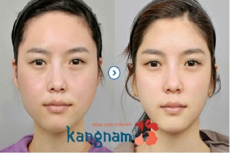 Kết quả khách hàng hút mỡ mặt tại Kangnam