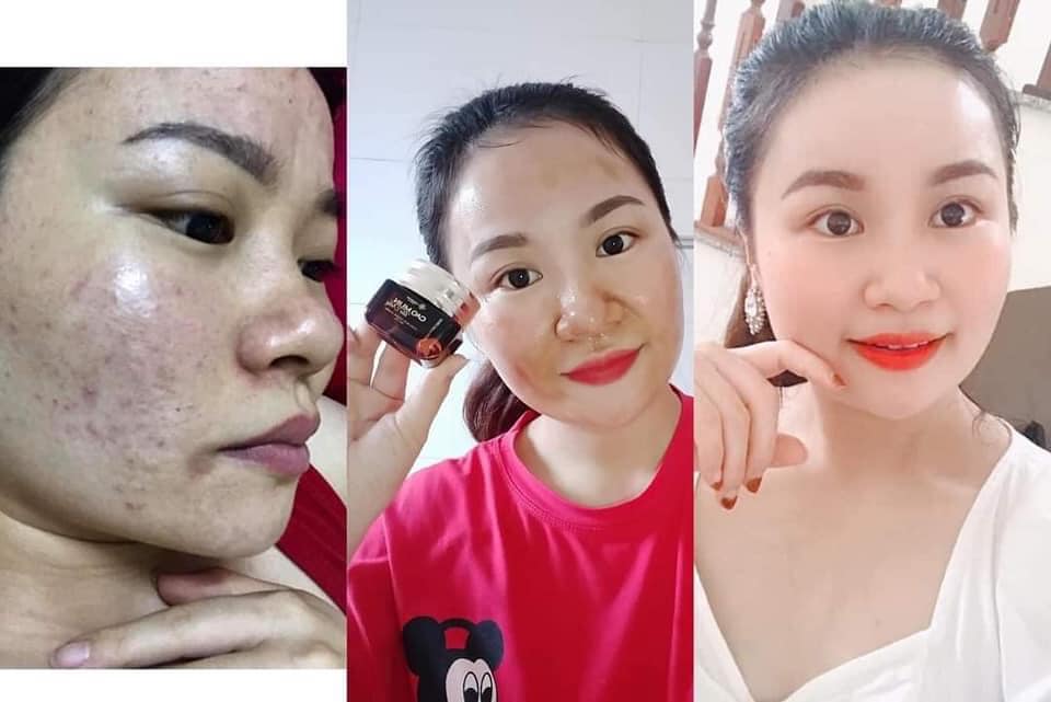 Cao mụn tảo nâu Huyền Phi