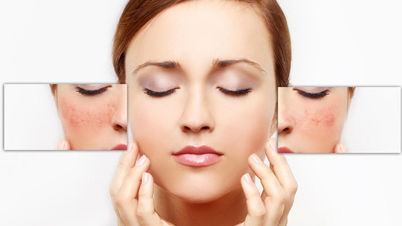 đặc điểm của làn da nám