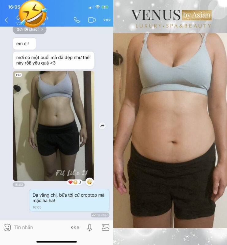 Review cấy tinh chất giảm béo tại Venus by Asian