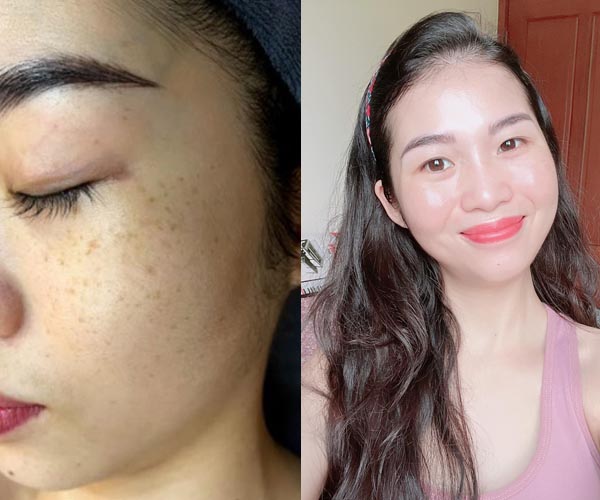 Hình ảnh trước và sau khi điều trị của chị Trang