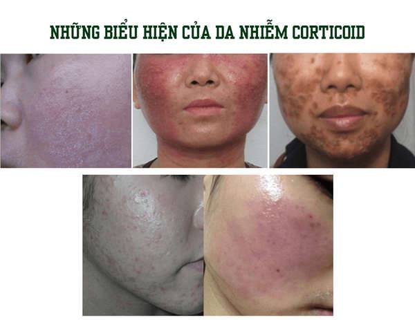 Những dấu hiệu của da nhiễm corticoid