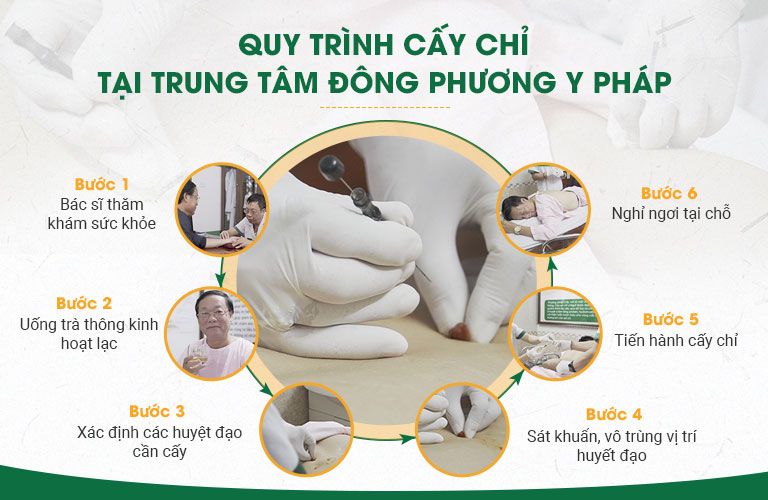 Quy trình cấy chỉ tại Trung tâm Thuốc dân tộc