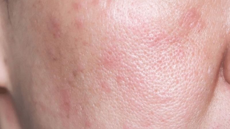 Sử dụng sulfur sai liều lượng sẽ gây kích ứng da