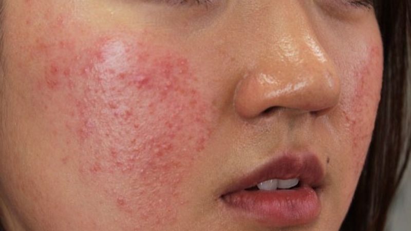 Da mặt dị ứng với lưu huỳnh