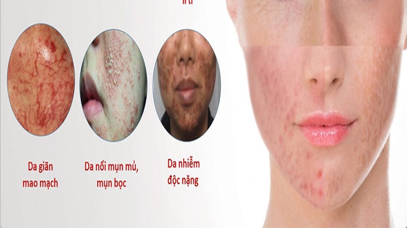 Một số dấu hiệu trên da khi dùng mỹ phẩm chứa corticoid