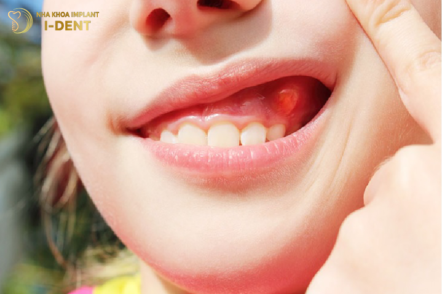 Tụt lợi, viêm nướu khi bọc răng sứ không uy tín