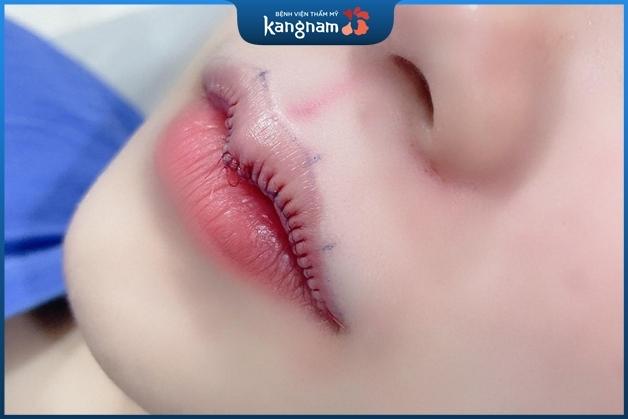 Thu gọn môi trên kết hợp tạo dáng môi trái tim đã mang tới sự thay đổi khác biệt cho khách hàng ngay sau phẫu thuật